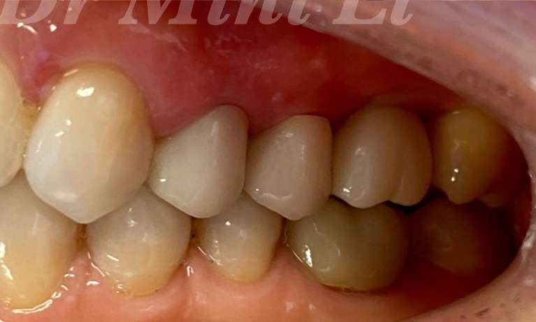 Dental-Implant-After-Image