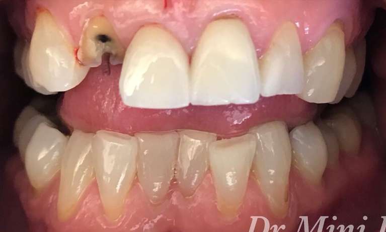 Crowns-and-Bridges-Before-Image