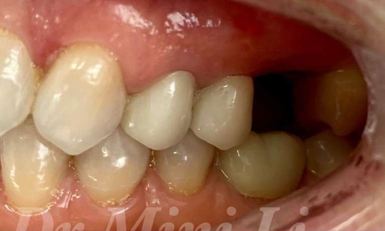 Dental-Implant-Before-Image