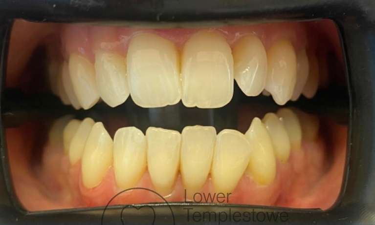 Teeth-Whitening-Before-Image